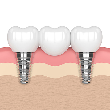 implant supported dentures